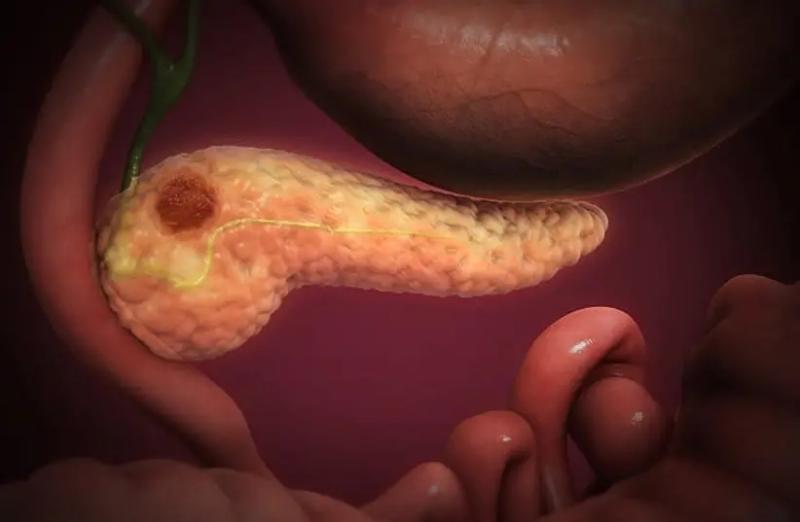 Israeli scientists find way to treat deadly pancreatic cancer in 14 days