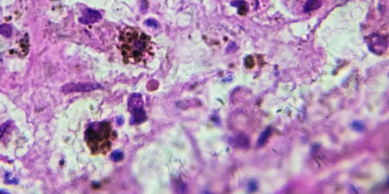 New cell-based therapy for melanoma more effective than existing treatment, trial finds