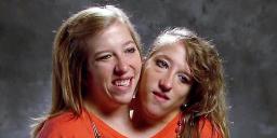Conjoined twin Abby Hensel is now married