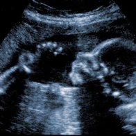 4D Chess: Baby About To Be Aborted Claims Squatter's Rights