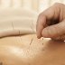 Chinese acupuncture reduces pain, anxiety in cancer surgery: Study