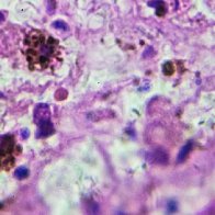 New cell-based therapy for melanoma more effective than existing treatment, trial finds