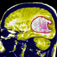 In two early trials, blood cancer treatment appears promising for deadly brain tumor