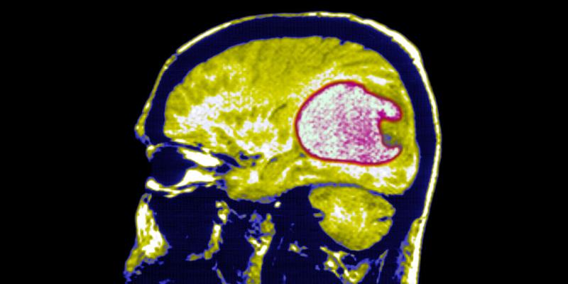 In two early trials, blood cancer treatment appears promising for deadly brain tumor