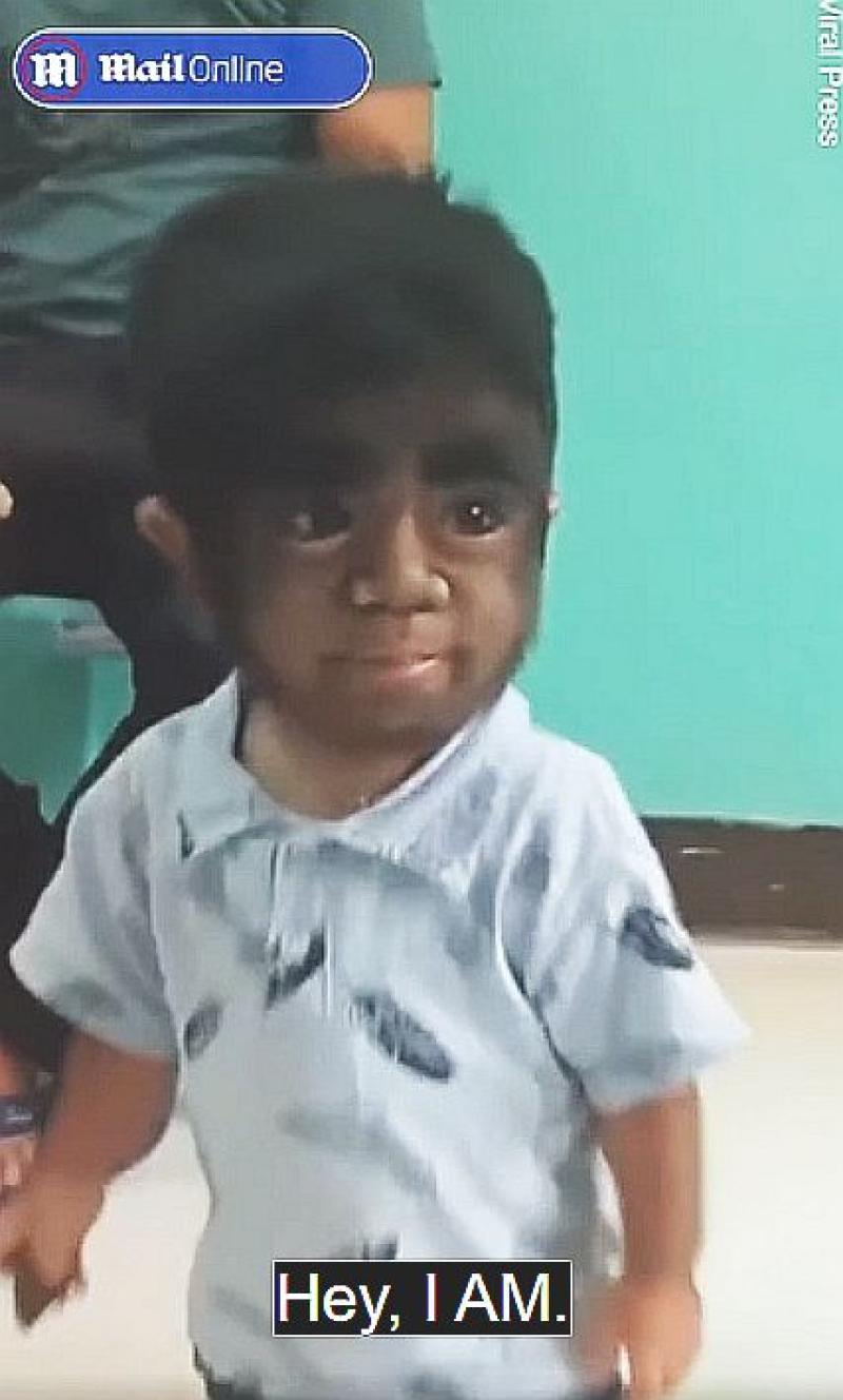 Boy has rare werewolf syndrome after mum 'ate cat during pregnancy'