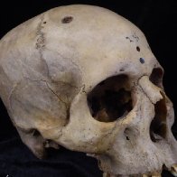 Ancient Egyptian skull shows oldest attempt at cancer surgery