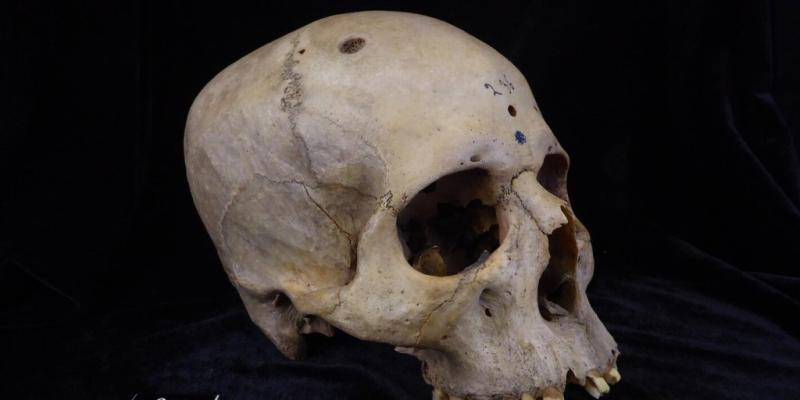 Ancient Egyptian skull shows oldest attempt at cancer surgery