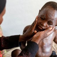 U.S. confirms first case of more aggressive strain of mpox