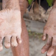 Leprosy Appears to Be on The Rise in Florida