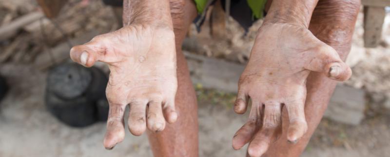 Leprosy Appears to Be on The Rise in Florida